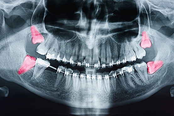 Southern Connecticut Oral   Maxillofacial Surgery   Implantology